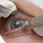 Cirurgia que altera cor do olho tem uso restrito para pessoas cegas